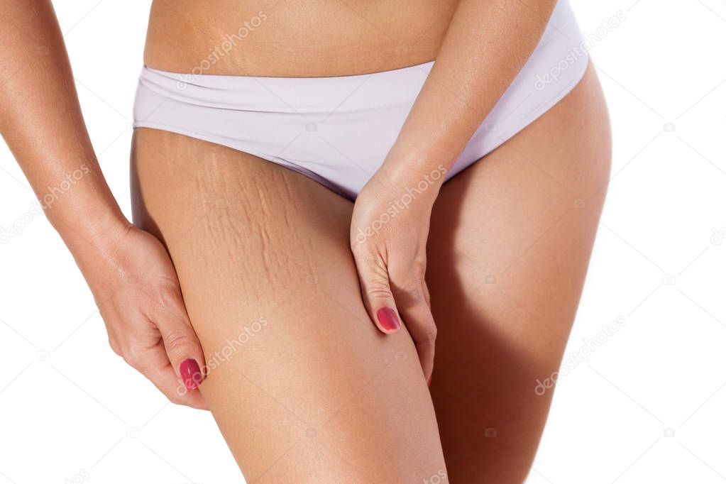Woman showing stretch marks 