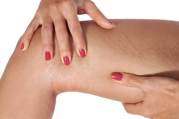 Woman examining stretch marks on her leg — Stock Photo, Image