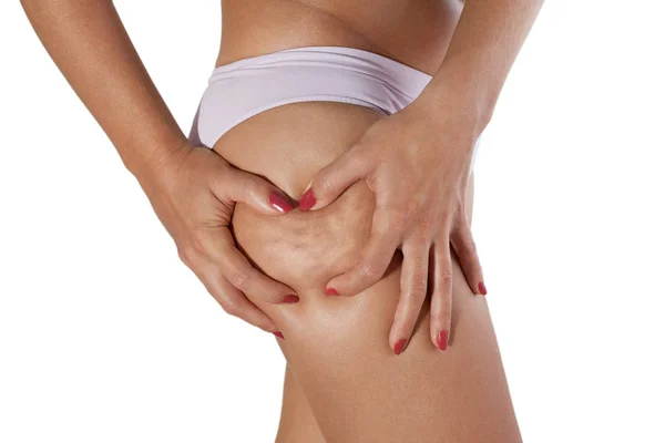 Woman showing cellulite on her thigh — Stock Photo, Image