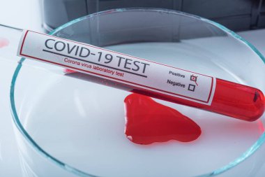 Coronavirus, Corona Virüsü laboratuarındaki masada bulunan numune tüpünde 19 enfekte kan örneği buldu.