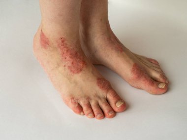 Beyaz arka planda kronik sedef hastalığından muzdarip bir kadının bacakları. Hastanın cildinde kızarıklık ve pullanma var. Dermatolojik sorunlar. Kuru cilt. İzole edilmiş