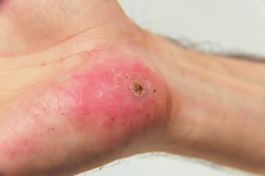 Motosikletten düşen bir adamın kolunda yaralanma. Avuçta çürük ve yara var. Avuç içinin arkasında deri lezyonları var.