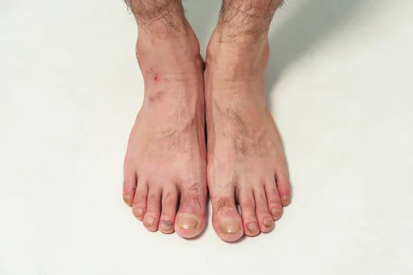 Male Nude Legs Close Feet Man Shoes Fungus Toenails Well — Stock Photo, Image