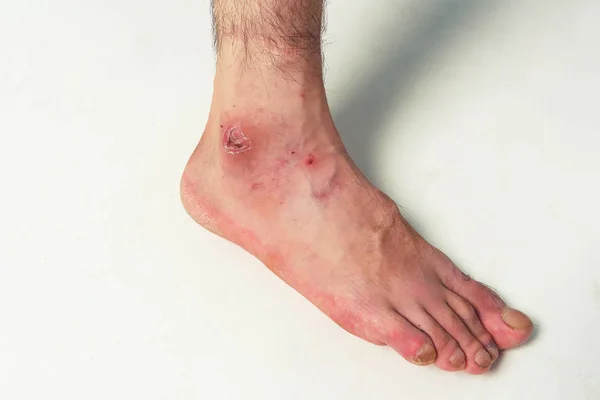 Τραυματισμός Του Δέρματος Μετά Από Πτώση Από Μοτοσικλέτα Στο Πόδι — Φωτογραφία Αρχείου