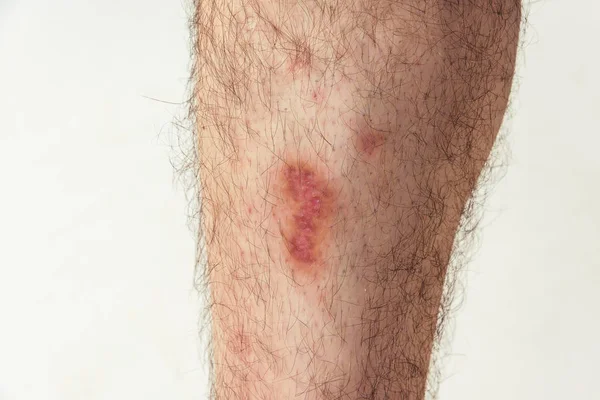 Zranění Kůže Pádu Motorky Mužské Noze Kožní Léze Těle Toho — Stock fotografie