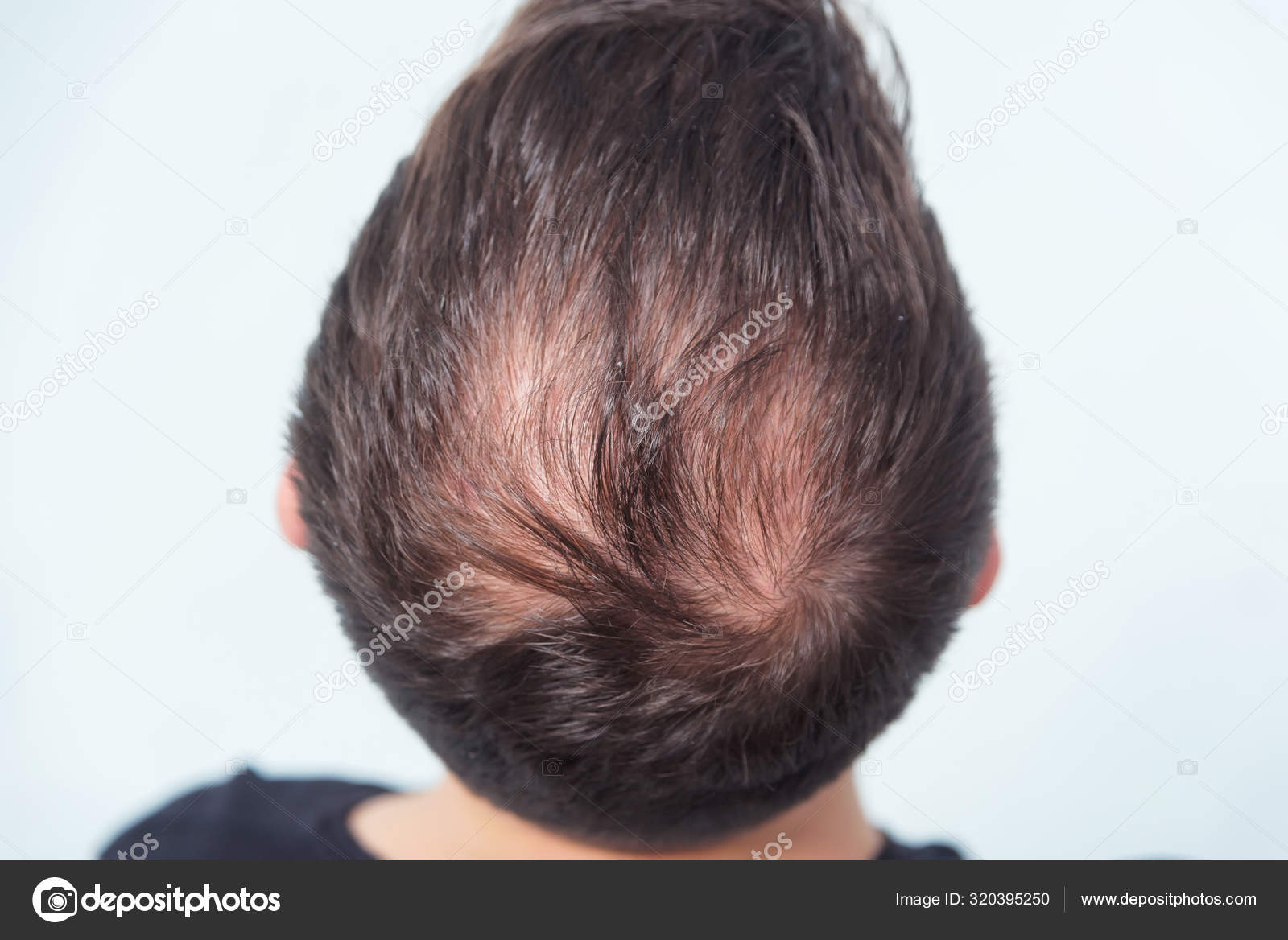 Early Male Pattern Baldness Hair Loss Young Man Beginning Bald Stock Photo by ©Kinderkz 320395250 Early Male Pattern Baldness Hair Loss Young Man Beginning Bald Stock Photo by ©Kinderkz 320395250