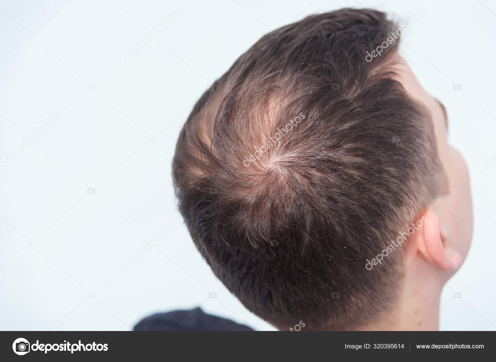 Tips for Hair Thinning Due to Male Pattern Baldness  AHS India