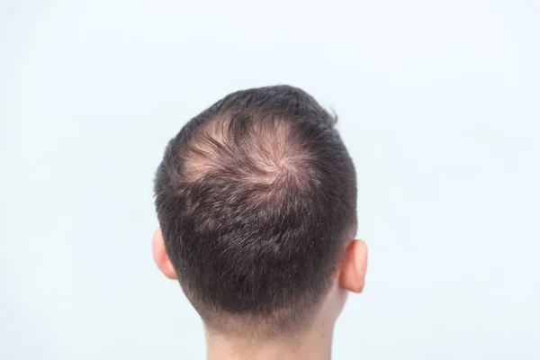 Early male pattern baldness. Hair loss in a young man. Beginning bald spot  on the head. Receding hairline on a man's head - Stock Image - Everypixel