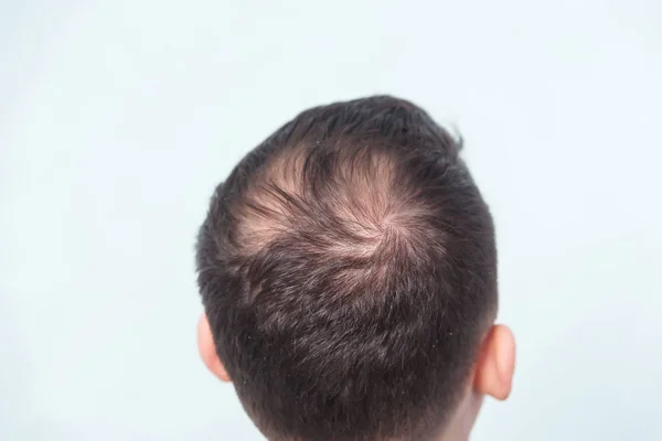 Raně Mužská Plešatost Ztráta Vlasů Mladého Muže Začíná Holé Místo — Stock fotografie