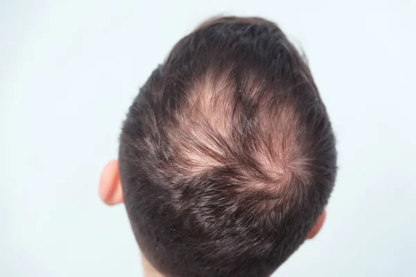 Calvície Masculina Precoce Perda Cabelo Num Jovem Começando Careca Cabeça — Fotografia de Stock