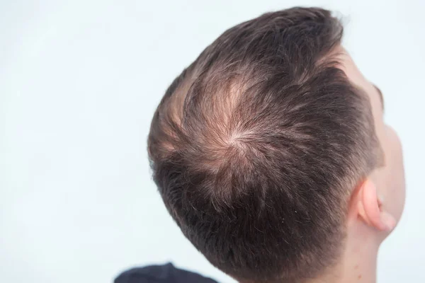 Early male pattern baldness. Hair loss in a young man. Beginning bald spot on the head. Receding hairline on a man\'s head