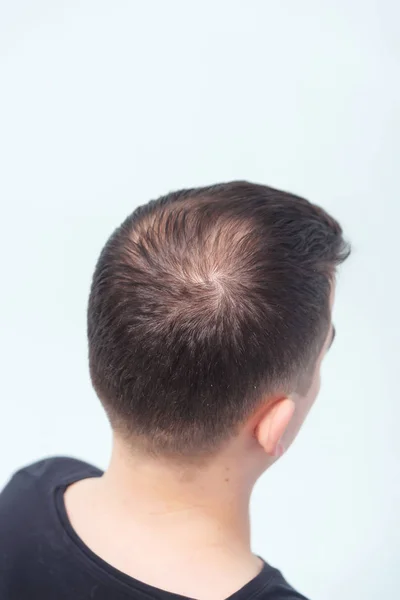 Early male pattern baldness. Hair loss in a young man. Beginning bald spot on the head. Receding hairline on a man\'s head