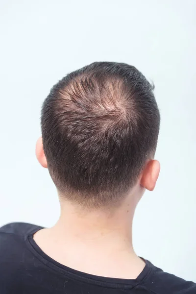 Male Pattern Baldness (Androgenic Alopecia): Stages, Treatment