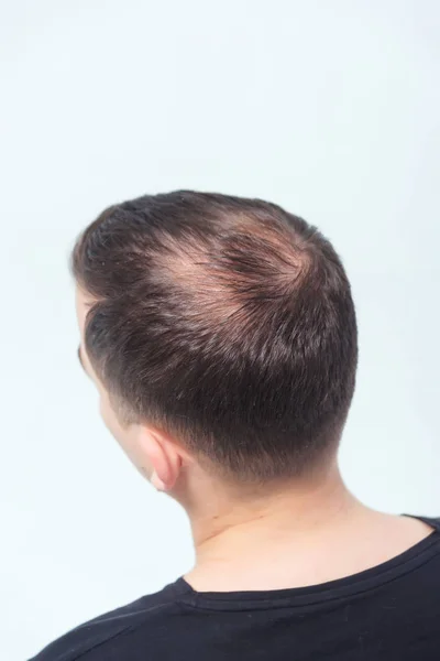Раннє Облисіння Чоловічої Статі Випадання Волосся Молодого Чоловіка Починається Лисиця — стокове фото