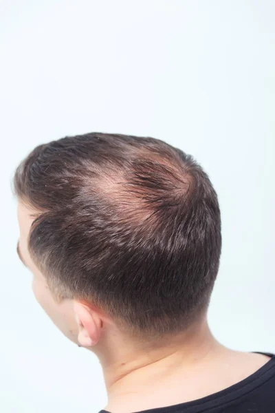 Calvície Masculina Precoce Perda Cabelo Num Jovem Começando Careca Cabeça — Fotografia de Stock