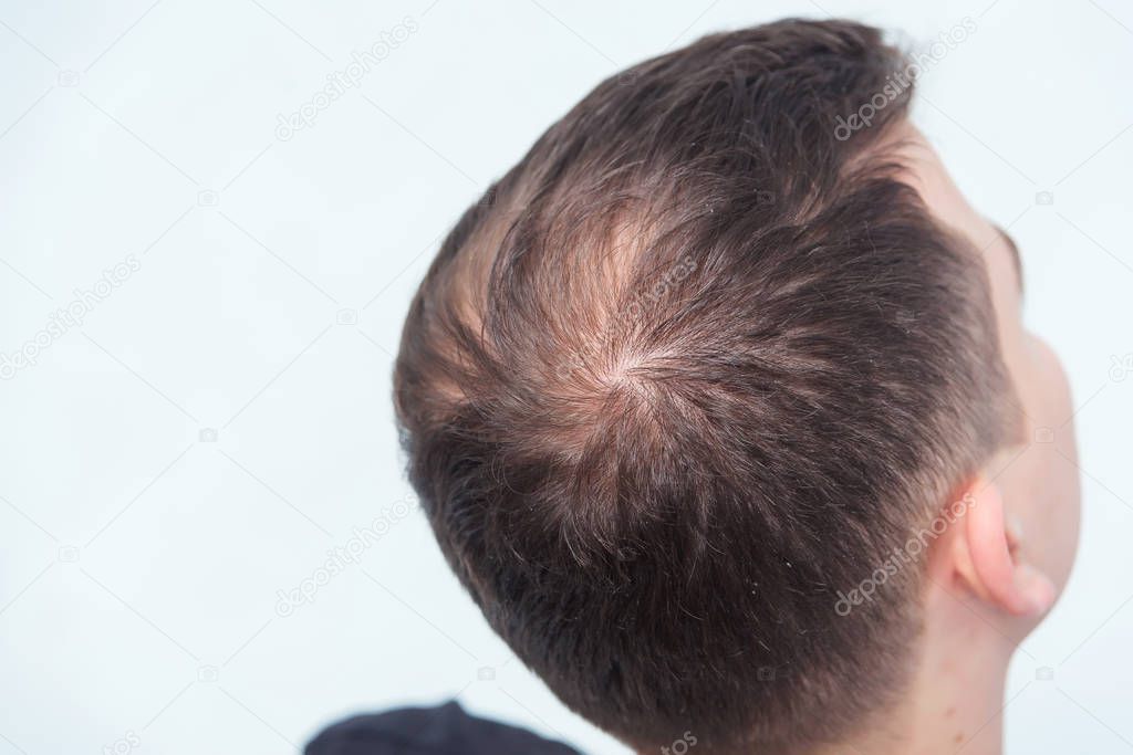 Early male pattern baldness. Hair loss in a young man. Beginning bald spot on the head. Receding hairline on a man's head
