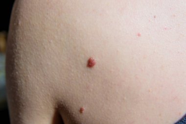 Ön kolunda büyük bir ben var. Bir adamın vücudundaki kanserli ben. Beyaz insan derisindeki benler ve benekler.