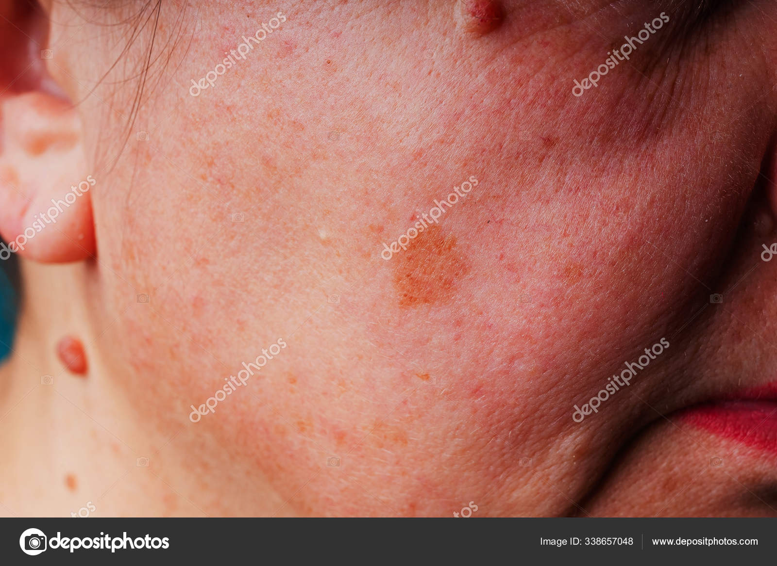 33 Skin s Moles Stock Photos Free Royalty Free Skin s Moles Images Depositphotos