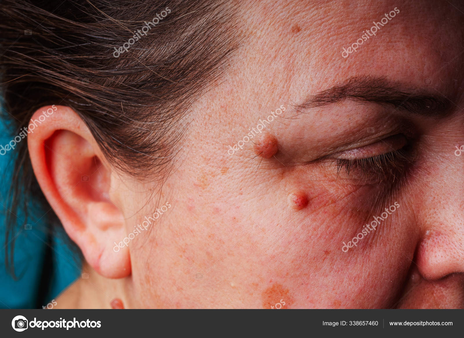 Large Moles Eye Close Red Large Moles Woman Face Inflammation Stock Photo C Kinderkz 338657460