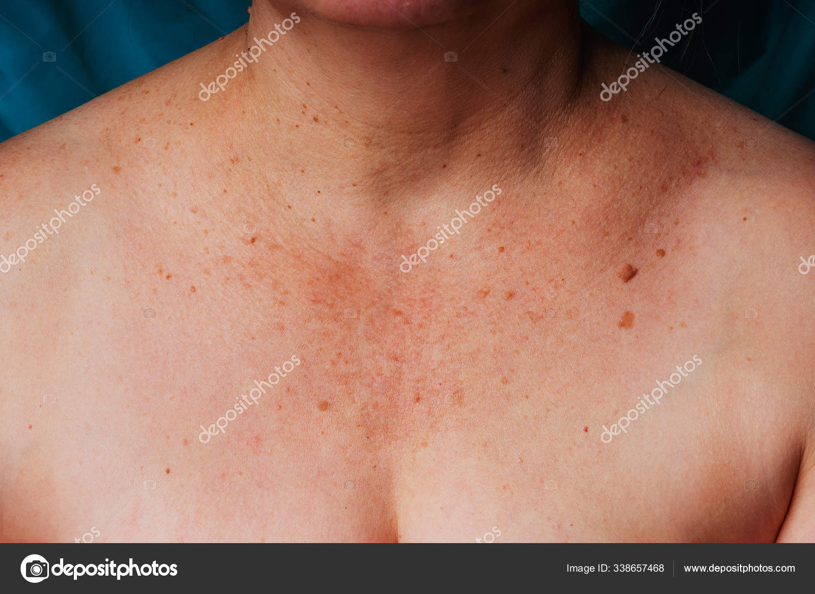 2 258 Age Spots Skin Stock Photos Free Royalty Free Age Spots Skin Images Depositphotos 2 258 Age Spots Skin Stock Photos Free Royalty Free Age Spots Skin Images Depositphotos