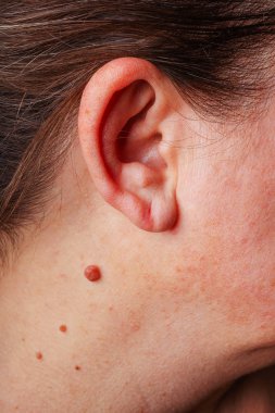 Large mole near the ear close-up. A red mole on the neck of an elderly woman. A large round mole of dark pink color on the woman's body.