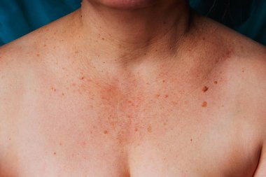 Age spots, moles and freckles on the neck and chest of an older woman. Spots on the body. Decollete area neckline of an elderly woman
