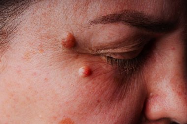 Large moles near the eye close-up. Red large round moles on the woman's face. Inflammation of the tear duct. A woman's reddened eye. Spots on the face and under the eyes in liver diseases