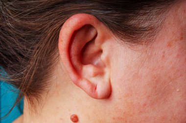 Large mole near the ear close-up. A red mole on the neck of an elderly woman. A large round mole of dark pink color on the woman's body.