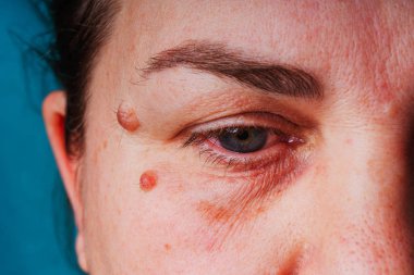 Large moles near the eye close-up. Red large round moles on the woman's face. Inflammation of the tear duct. A woman's reddened eye. Spots on the face and under the eyes in liver diseases