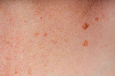 Age spots, moles and freckles on the body close-up. Spots on the body. The texture of the skin with moles and freckles