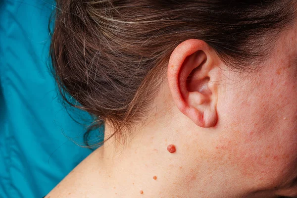 Large mole near the ear close-up. A red mole on the neck of an elderly woman. A large round mole of dark pink color on the woman's body.