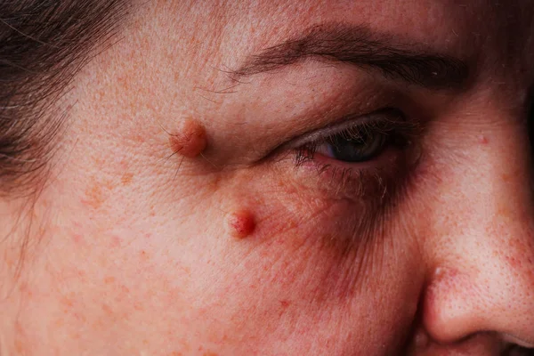 Large moles near the eye close-up. Red large round moles on the woman\'s face. Inflammation of the tear duct. A woman\'s reddened eye. Spots on the face and under the eyes in liver diseases