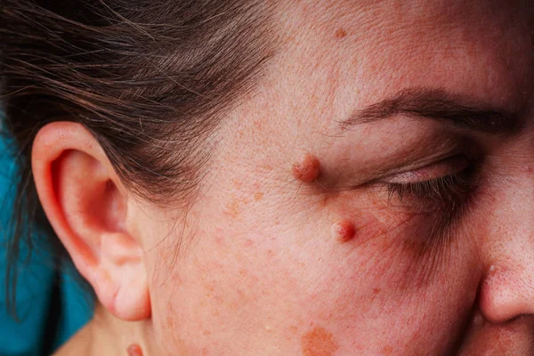 Large moles near the eye close-up. Red large round moles on the woman\'s face. Inflammation of the tear duct. A woman\'s reddened eye. Spots on the face and under the eyes in liver diseases