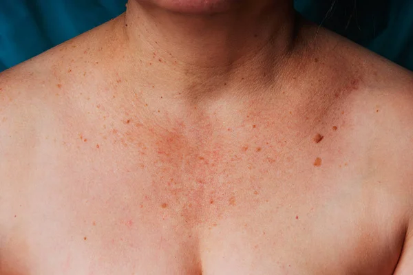 Manchas Edad Lunares Pecas Cuello Pecho Una Mujer Mayor Manchas — Foto de Stock