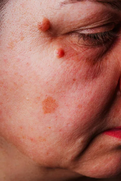 Large moles near the eye close-up. Red large round moles on the woman's face. Inflammation of the tear duct. A woman's reddened eye. Spots on the face and under the eyes in liver diseases