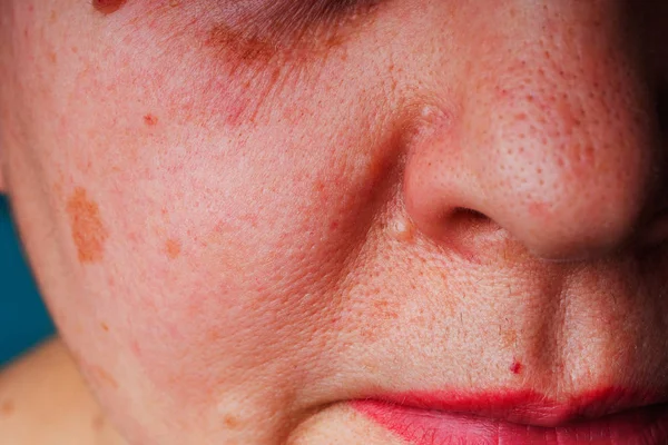 Age spots, moles and freckles on the face close-up. Spots on the skin of the face. Texture of middle-aged female skin