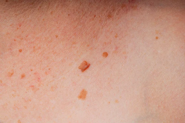 Age spots, moles and freckles on the body close-up. Spots on the body. The texture of the skin with moles and freckles