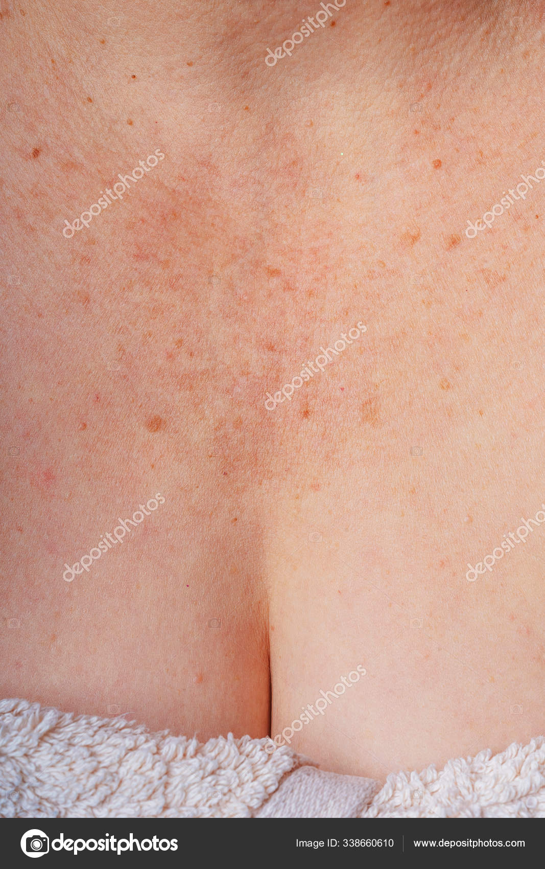 Age Spots Moles Freckles Neck Chest Older Woman Spots Body Stock Photo By C Kinderkz Age Spots Moles Freckles Neck Chest Older Woman Spots Body Stock Photo By C Kinderkz
