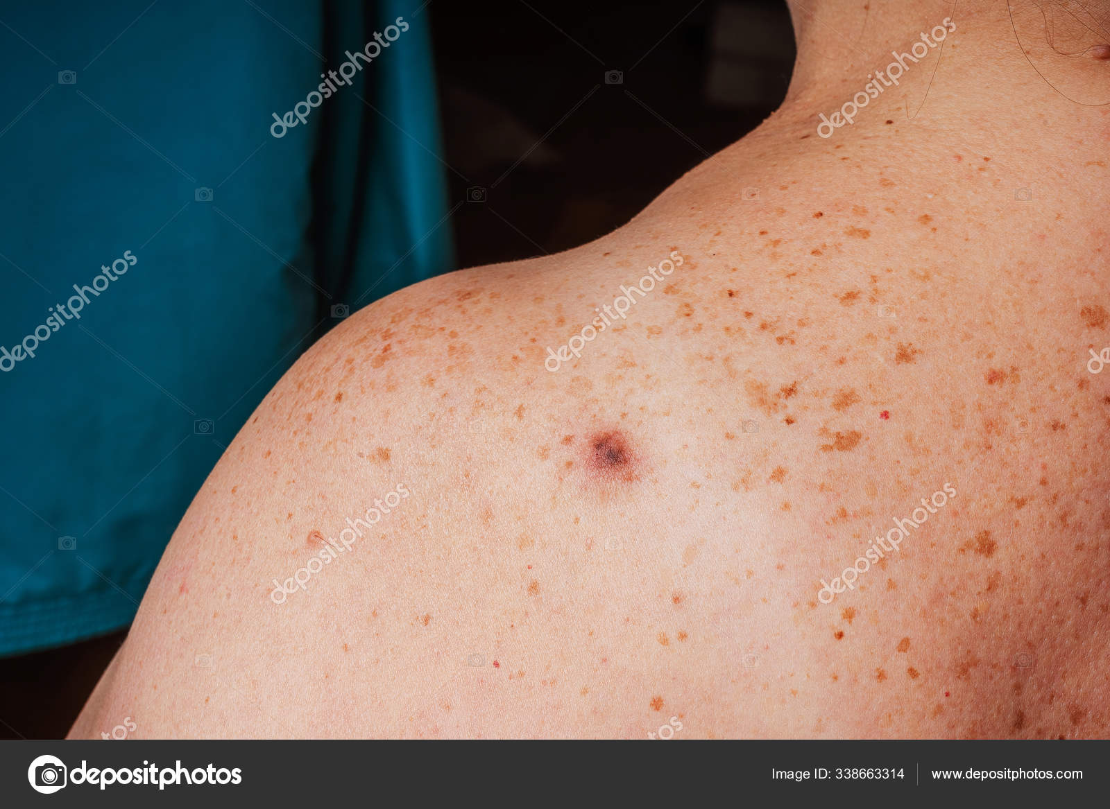 Age Spots Moles Freckles Shoulders Back Older Woman Pigmentation Shoulder Stock Photo By C Kinderkz Age Spots Moles Freckles Shoulders Back Older Woman Pigmentation Shoulder Stock Photo By C Kinderkz