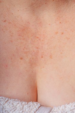 Age spots, moles and freckles on the neck and chest of an older woman. Spots on the body. Decollete area neckline of an elderly woman