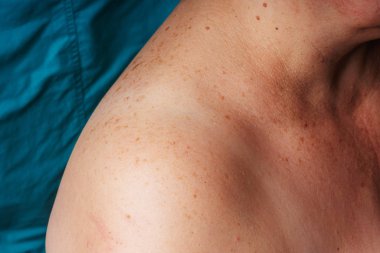 Age spots, moles and freckles on the shoulders and back of an older woman. Pigmentation on the shoulder. Spots on the body.