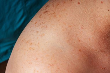 Age spots, moles and freckles on the shoulders and back of an older woman. Pigmentation on the shoulder. Spots on the body.