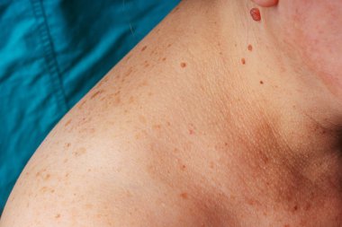 Age spots, moles and freckles on the shoulders and back of an older woman. Pigmentation on the shoulder. Spots on the body.