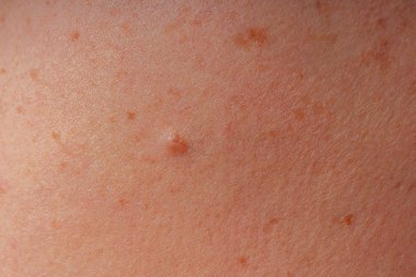 Age spots, moles and freckles on the body close-up. Spots on the body. The texture of the skin with moles and freckles