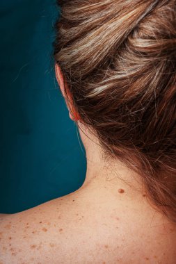 Yaşlı bir kadının sırtında yaş lekeleri, benler ve çiller var. Arkasında pigmentasyon var. Vücutta lekeler