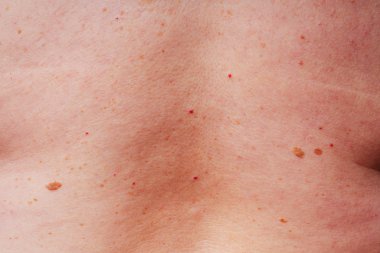 Age spots, moles and freckles on the body close-up. Spots on the body. The texture of the skin with moles and freckles