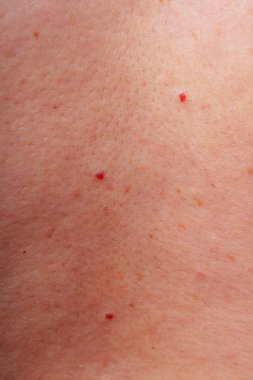 Age spots, moles and freckles on the body close-up. Spots on the body. The texture of the skin with moles and freckles