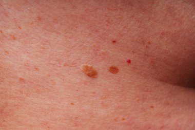Age spots, moles and freckles on the body close-up. Spots on the body. The texture of the skin with moles and freckles