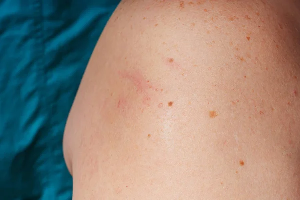 Age Spots Moles Freckles Shoulders Back Older Woman Pigmentation Shoulder — ストック写真