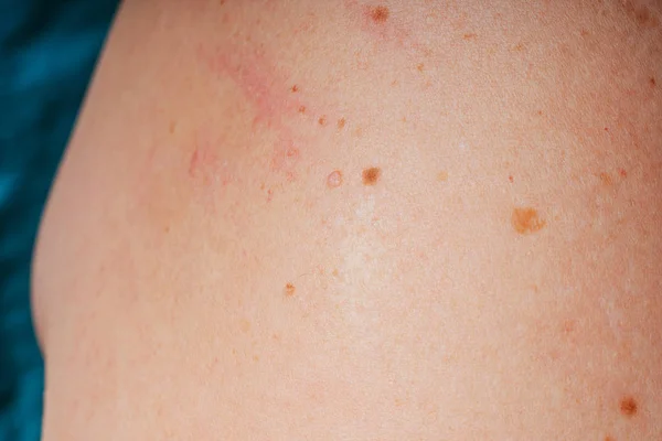Age Spots Moles Freckles Body Close Spots Body Texture Skin — Stockfoto